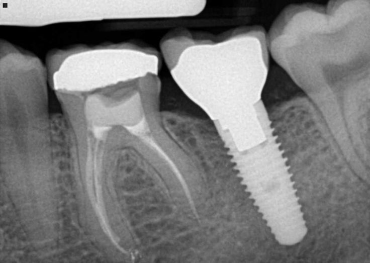 X-ray of an implant in position